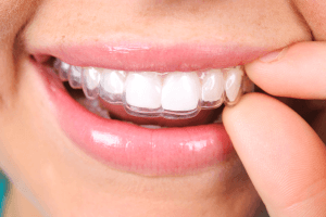 How Does Invisalign Work