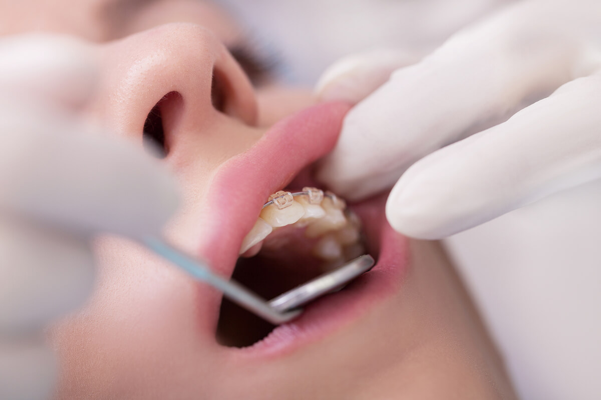 Braces Vs. Invisalign Cost  Oral health care, Natural oral care