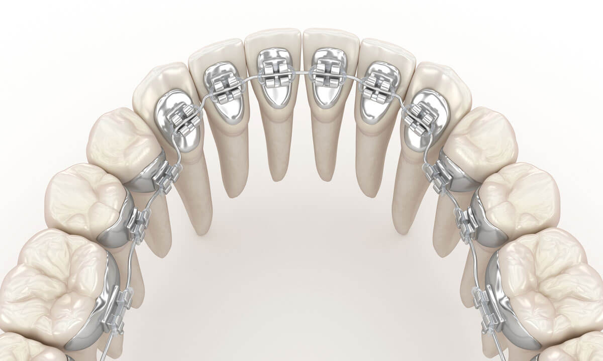 Lingual Braces (Inside Braces), Ortho, Orthodontics